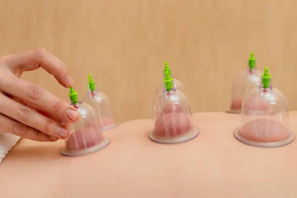 Cupping therapy feature photo