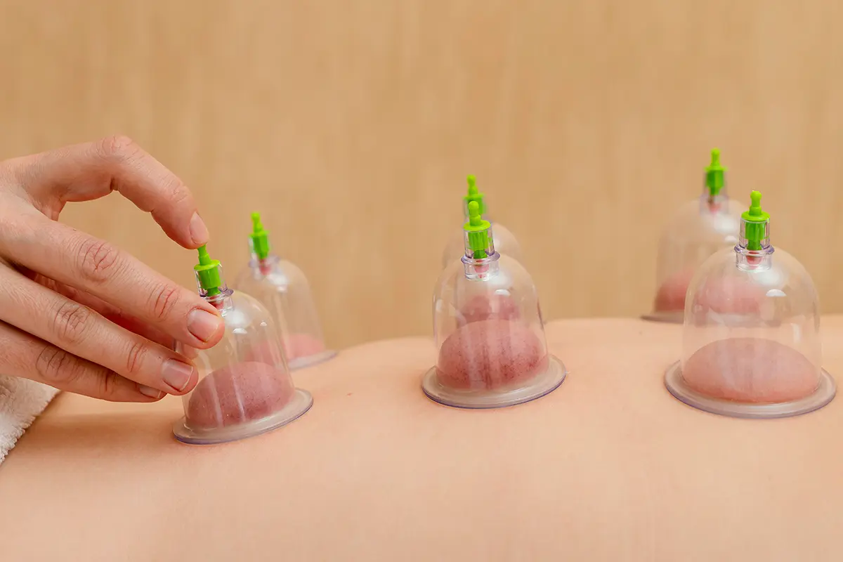Cupping therapy feature photo
